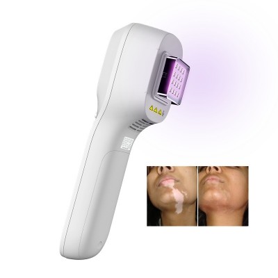 KN-5000H Portable LED Excimer 308nm laser for vitiligo psoriasis